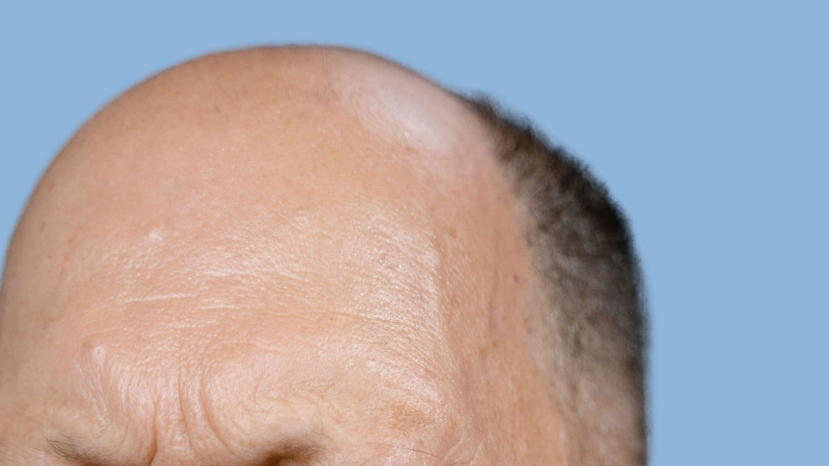 How to Remove Hair System Adhesive Safely