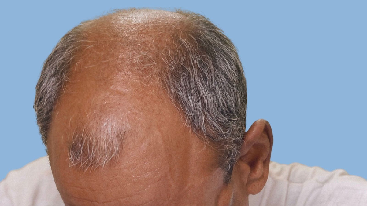How Often Should You Take a Break from Your Hair System?